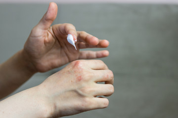 Allergic woman hands with cream