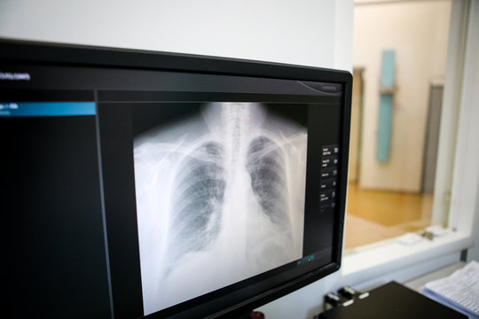 Details with a thoracic X-Ray on a computer monitor inside a clinic