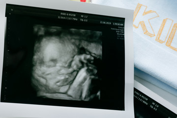 3d/4d ultrasound film show baby boy in womb on white back ground. Pregnancy concept.