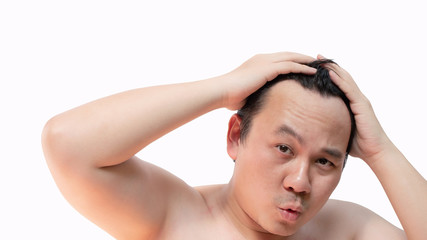 Naklejka premium Asian bald man alopecia or hair loss isolated on white background with copy space.