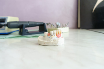 Artificial removable dental prosthesis