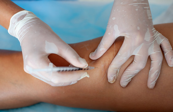 Doctor in medical gloves introduces sclerotherapy on woman's legs, close up
