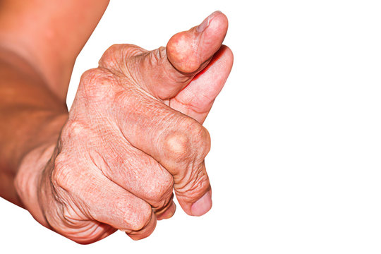 Severe gout in men suffering from joint pain, bone pain, gout, rheumatoid symptoms, radioactive sickness, ill man concept of male osteoporosis, injured bone, injury, pain, arthritis,arm, foot, knee
