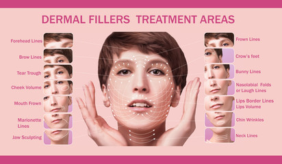 Treatment areas for anti-wrinkle injection.