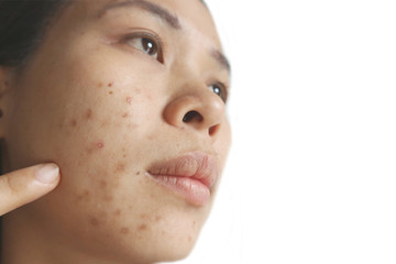 Asian woman,her face is inflamed acne caused by steroid-containing cosmetics.