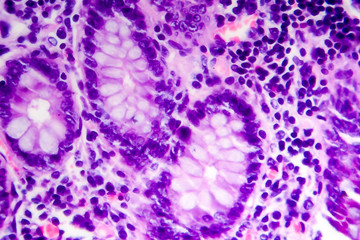 Poorly differentiated intestinal adenocarcinoma, light micrograph, photo under microscope. High magnification