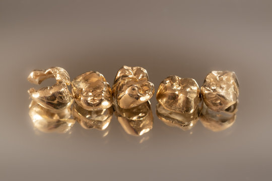 Zahngold: F&uuml;nf alte Kronen (Gold-Recycling)