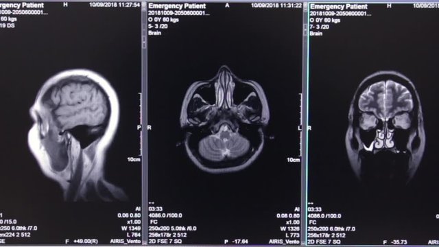 moving image of a skull on an MRI