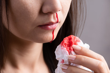 Nosebleed , a young woman suffering from nose bleeding and using tissue paper for stop bleeding....