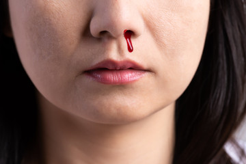Nosebleed , a young woman with a bloody nose. Healthcare and medical concept.