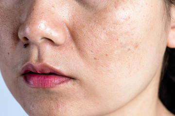 Woman with problematic skin and acne scars. Problem skincare and health concept. Wrinkles melasma...