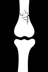 Bone fracture - cracks and deterioration of skeleton - injury and disease. Vector illustration. 