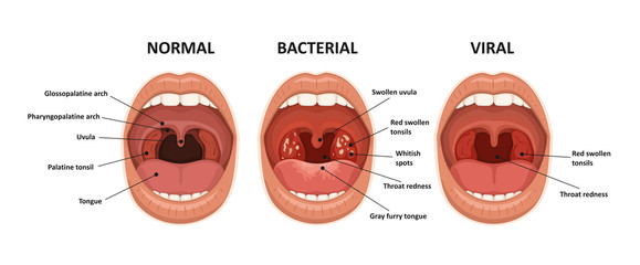 Tonsillitis bacterial and viral. Angina, pharyngitis and tonsillitis. Infection of tonsils. Open mouth