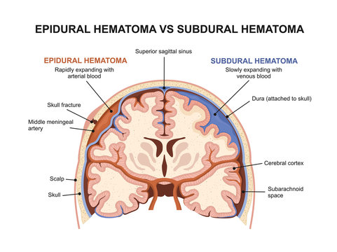 Epidural hematoma vs subdural hematoma