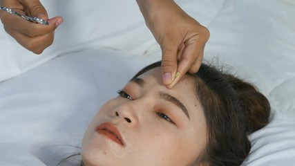 young woman undergoing acupuncture treatment on face