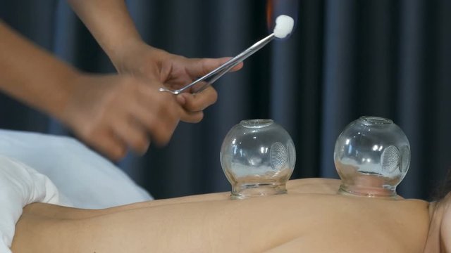 close up glass cup with fire for cupping treatment on female back
