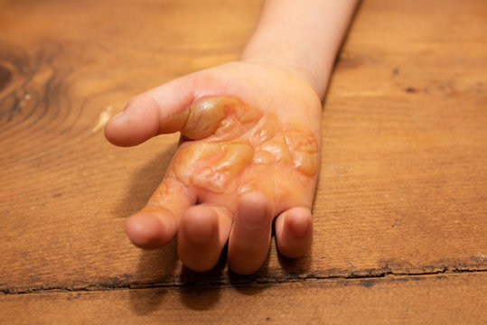 火傷をした子供の手