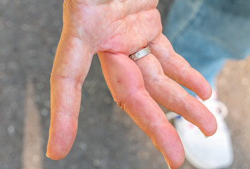 August 2019: a right hand with a bee bite, swelling hand, swollen finger