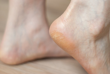 Fototapeta premium clavus and cracks on the heel of the foot