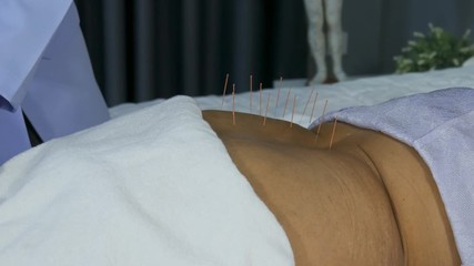Close-up of senior female back with steel needles during procedure of the acupuncture therapy