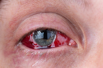 postoperative heavy inflamed eye closeup shot with selective focus
