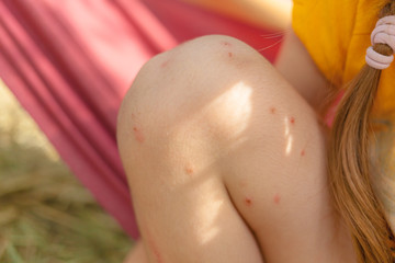 Mosquito bites on a leg of a girl.