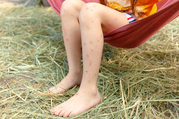 A shot of mosquitoes and bugs bite and scar spot on girl's legs sitting on the hammock