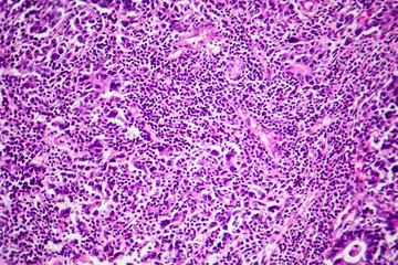 Gastric adenocarcinoma, light micrograph, photo under microscope