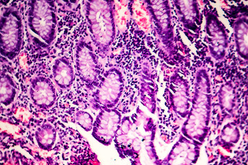 Poorly differentiated intestinal adenocarcinoma, light micrograph, photo under microscope