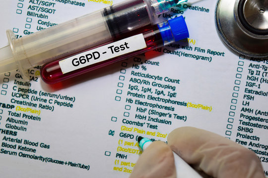 G6PD - Test with blood sample. Top view isolated on office desk. Healthcare/Medical concept