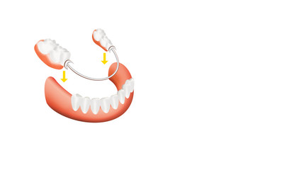 Closeup of dental skeletal prosthesis with porcelain crowns