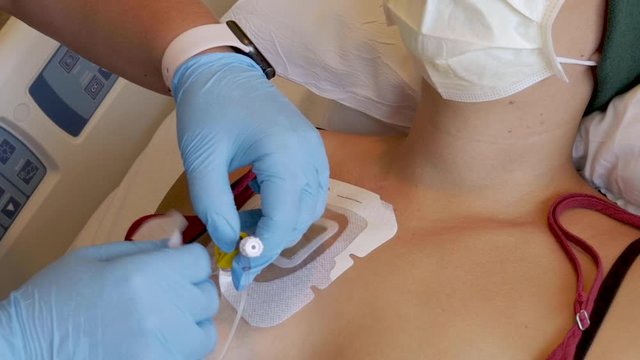 Close Up Of A Woman With A Central Venous Line Getting Prepared For Chemotherapy