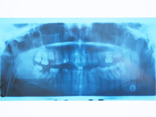 Panoramic dental x-ray of humans teeth