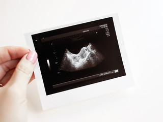 Ultrasound of baby in pregnant woman