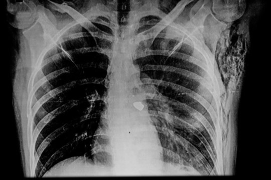 Mature Man X-ray Showing A Right Pulmonary Artery Bullet And Left Subcutaneous Emphysema