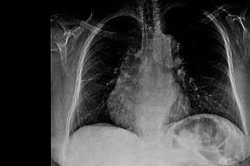 Right ventricle enlargement