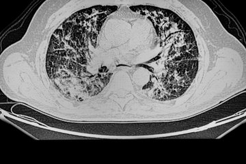 CAT Scan: Lung infection