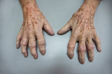 Mature patient with a osteoarthritis - obrazy, fototapety, plakaty