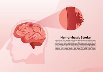 Human brain stroke illustration.