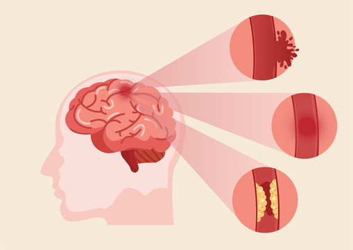 Human Brain Stroke Illustration.