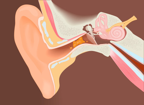 Section of the ear with the wax