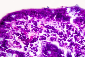 Villous colon adenocarcinoma, light micrograph, photo under microscope. High magnification
