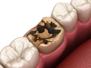 Caries removing process. Medically accurate tooth 3D illustration.