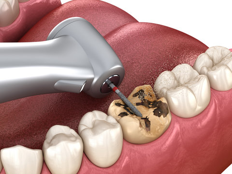 Caries removing process. Medically accurate tooth 3D illustration.