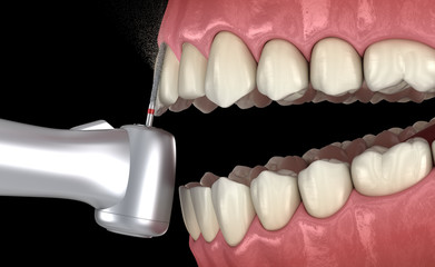 Central Incisor preparation process for dental Veneer placement. Medically accurate 3D illustration