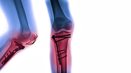 X-ray image of Tibia fracture show operation surgery fix by plate and screw. Medical and health care concepts.