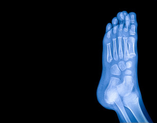 X-ray image of child foot with copy space for medical and health care concepts.