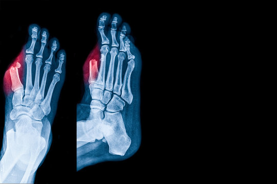 X-ray image of foot show diabetic wound infected to big toe bone cause to Toe amputation in Diabetes patient. Medical health care concepts.