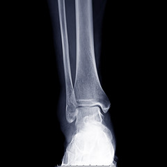 X-ray ankle joint or Radiographic image or x-ray image of right ankle joint for diagnostic bone fracture.
