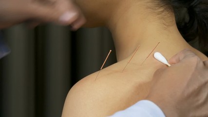 young woman undergoing acupuncture treatment on shoulder